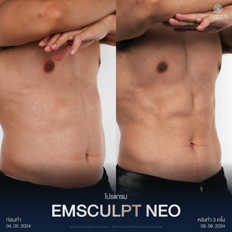 รีวิว ปั้นร่อง 11 ด้วย เครื่อง EMSCLPT NEO
